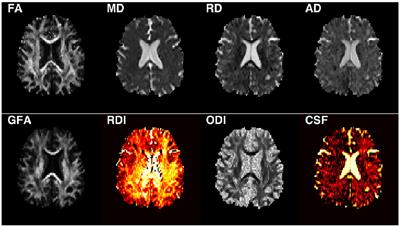 Predicting Motor Outcomes in Stroke Patients Using Diffusion Spectrum MRI Microstructural Measures
